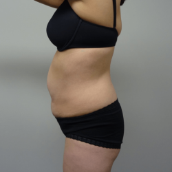 Manhattan abdominoplasty before 5